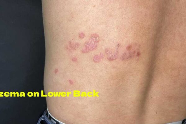 Eczema on lower back