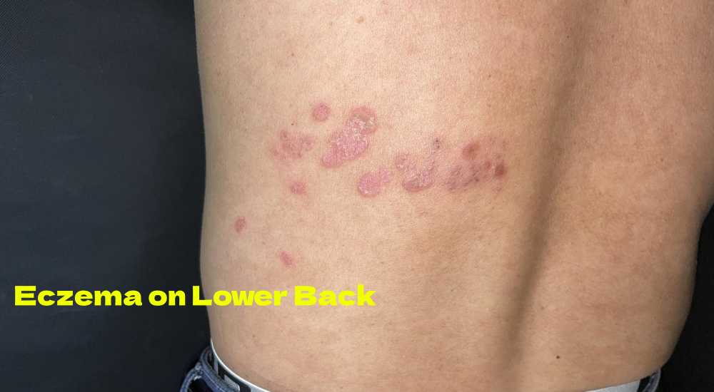 Eczema on lower back