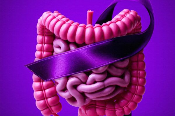 Crohn’s Disease