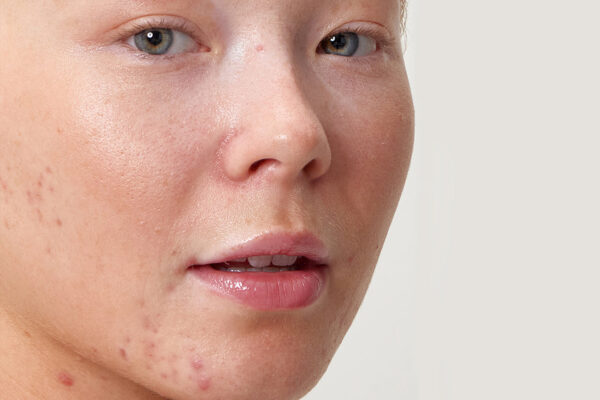Does Acne Scar Treatment Fade Red Marks?
