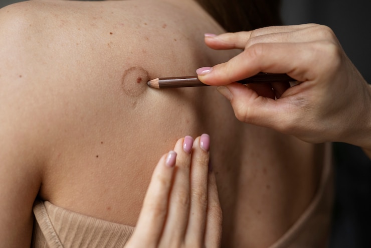 Does Warts Removal Treatment Work Permanently?