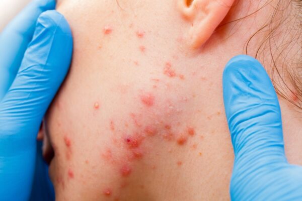 Does a Dermatologist Assess Skin Bumps