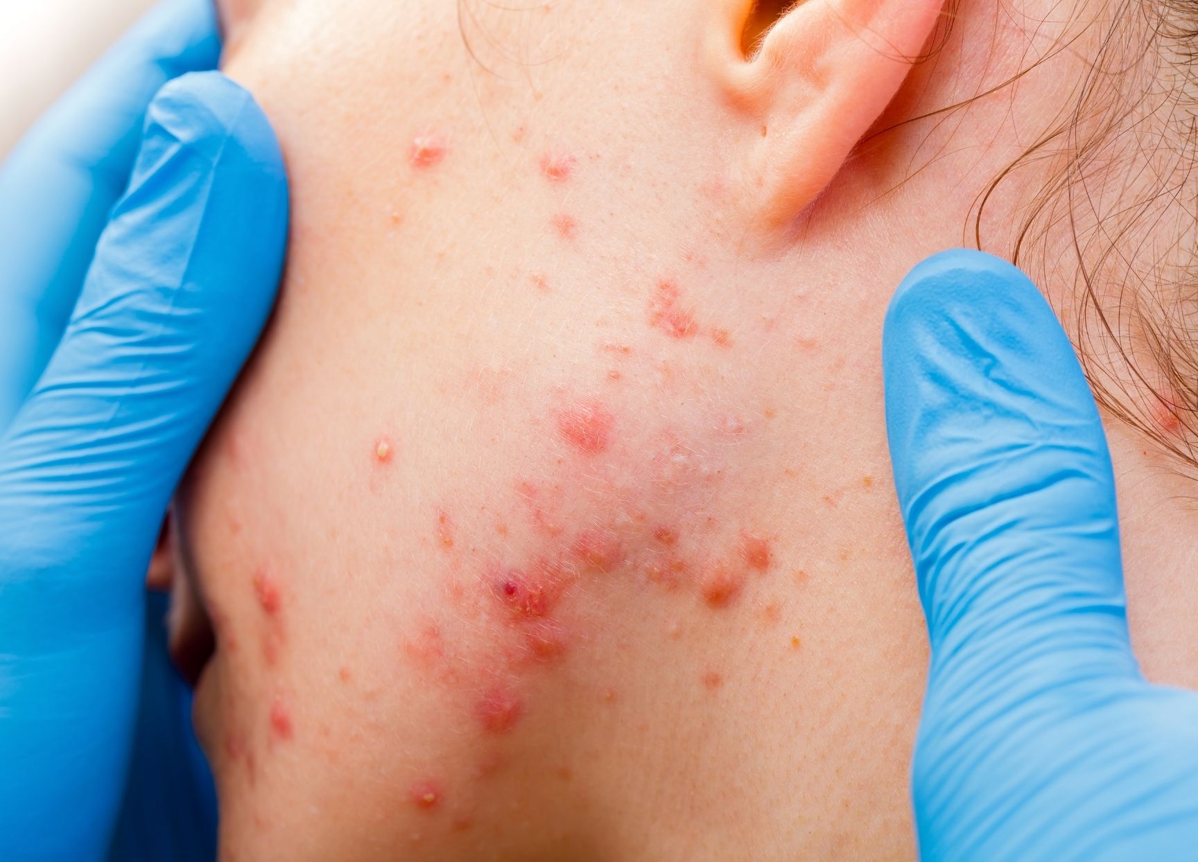 Does a Dermatologist Assess Skin Bumps