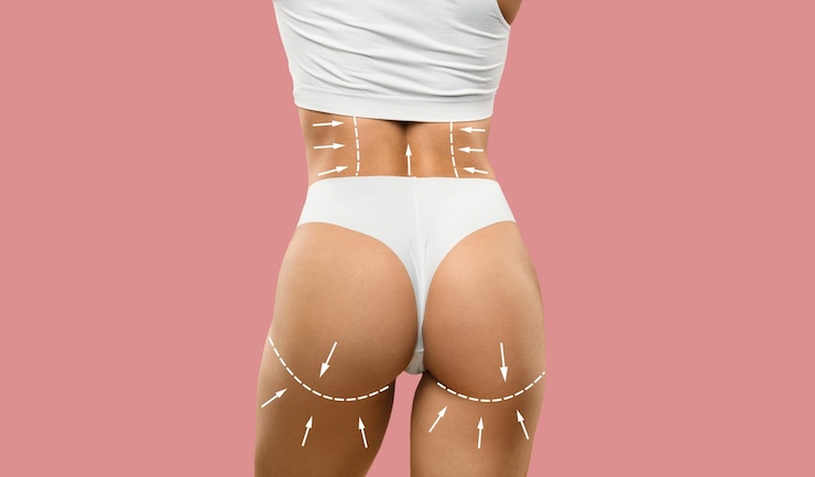 How Long Does Brazilian Butt Lift Last