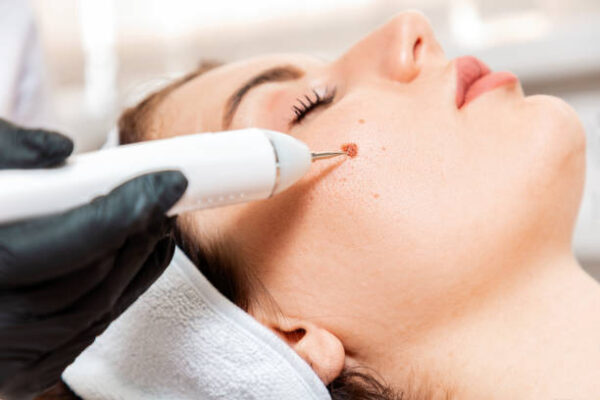 How Many Sessions for Warts Removal