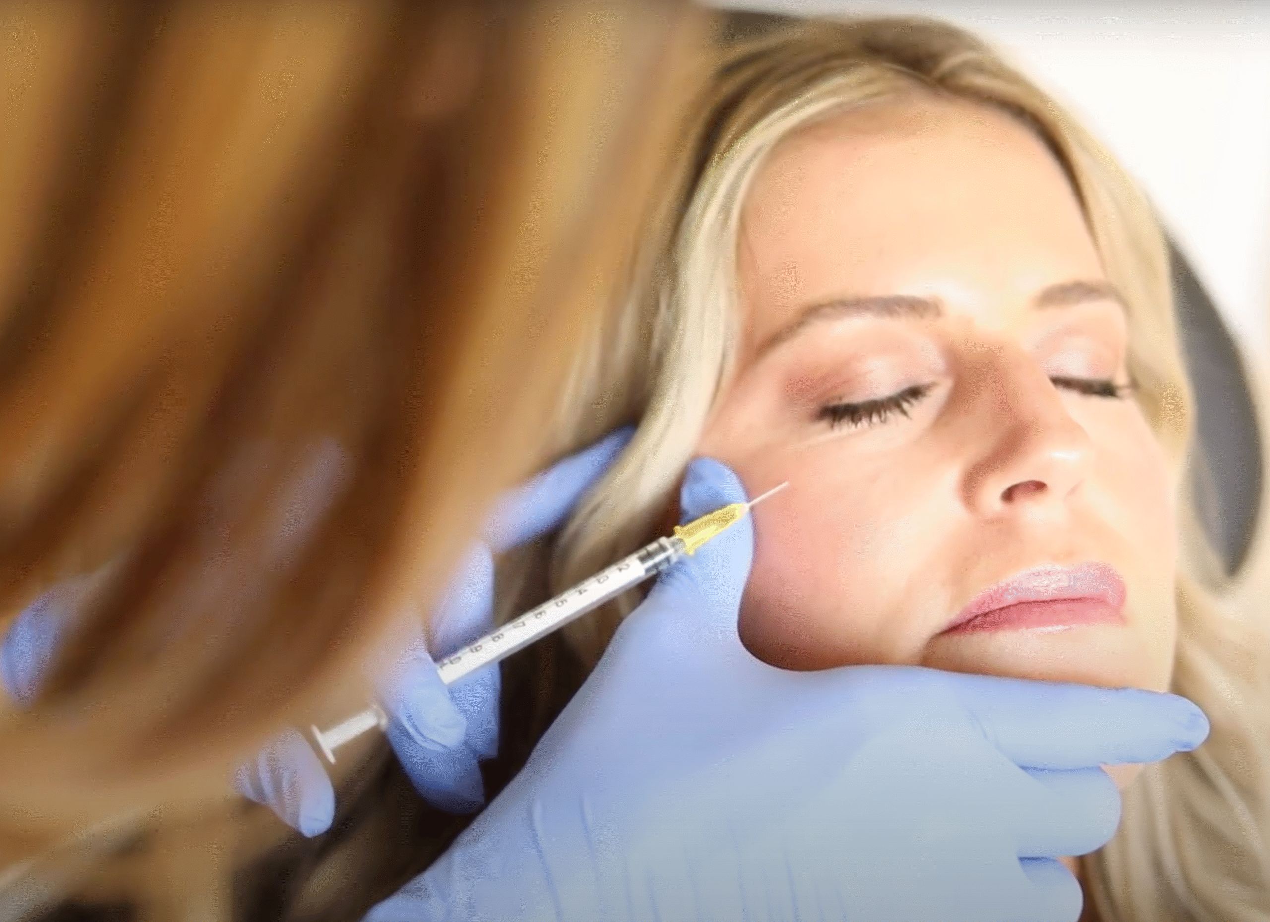 Is PRP Treatment Better Than Botox or Fillers?