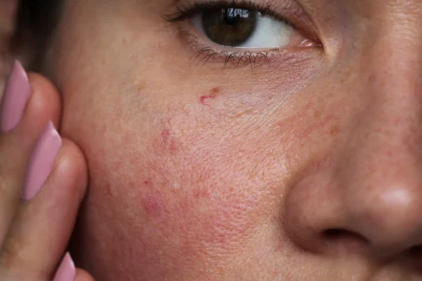 Clear Skin Without the Sting: Acne Solutions for Sensitive Skin