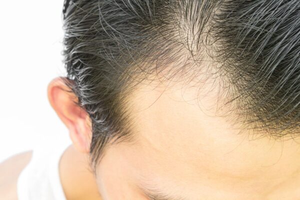 What Can Finasteride for Hair Loss Improve