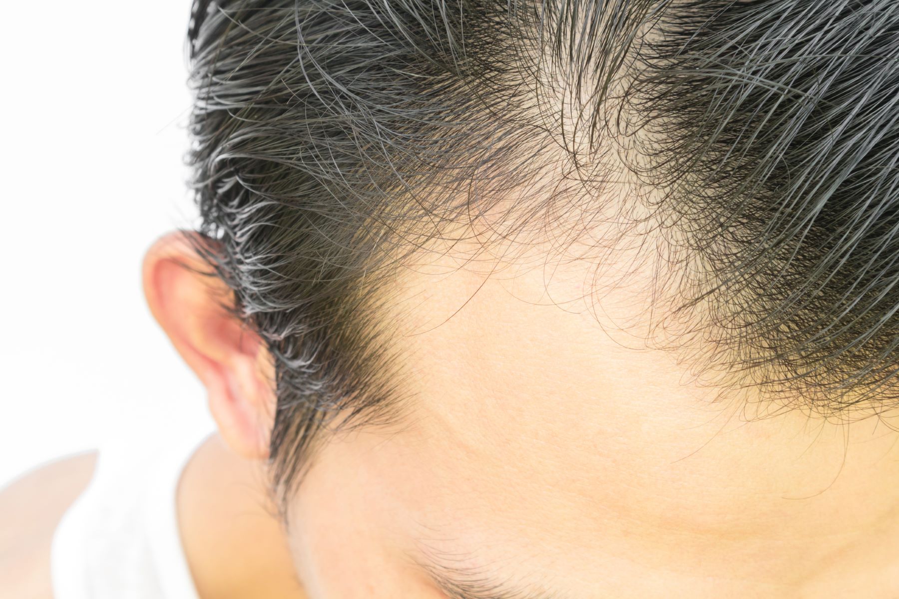 What Can Finasteride for Hair Loss Improve