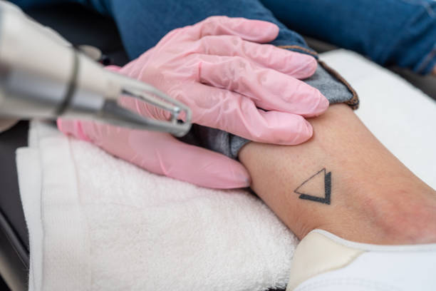 What Results to Expect from Laser Tattoo Removal