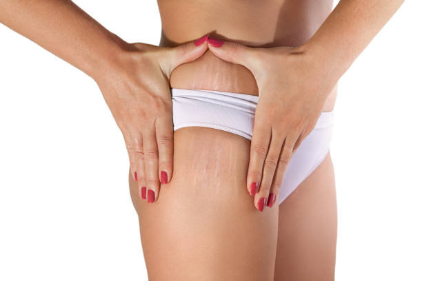 What To Expect From Stretch Mark Removal