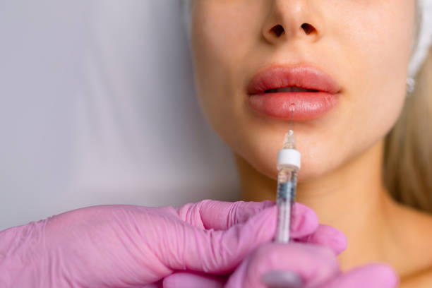 What to Expect From Russian Lip Fillers