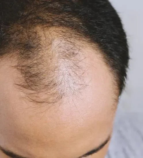hair transplant in dubai