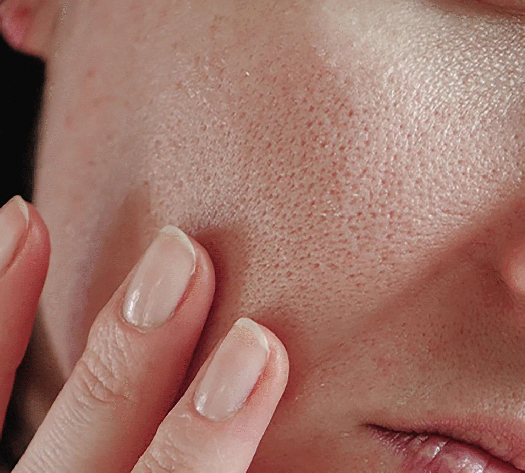 Large Pores Treatment