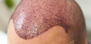 How Long Before Hair Grows After a Transplant? hair transplant in dubai