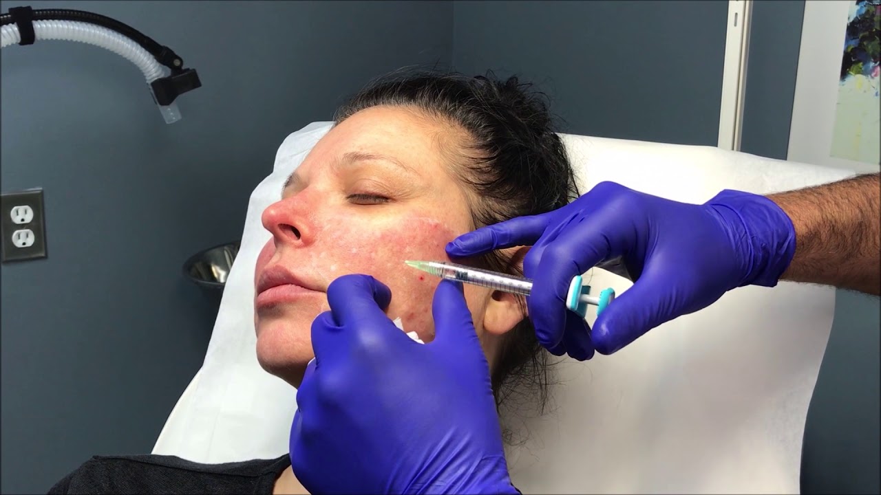 Volite fillers in Dubai