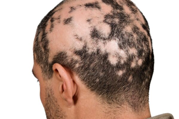 Best Trichologist in Dubai