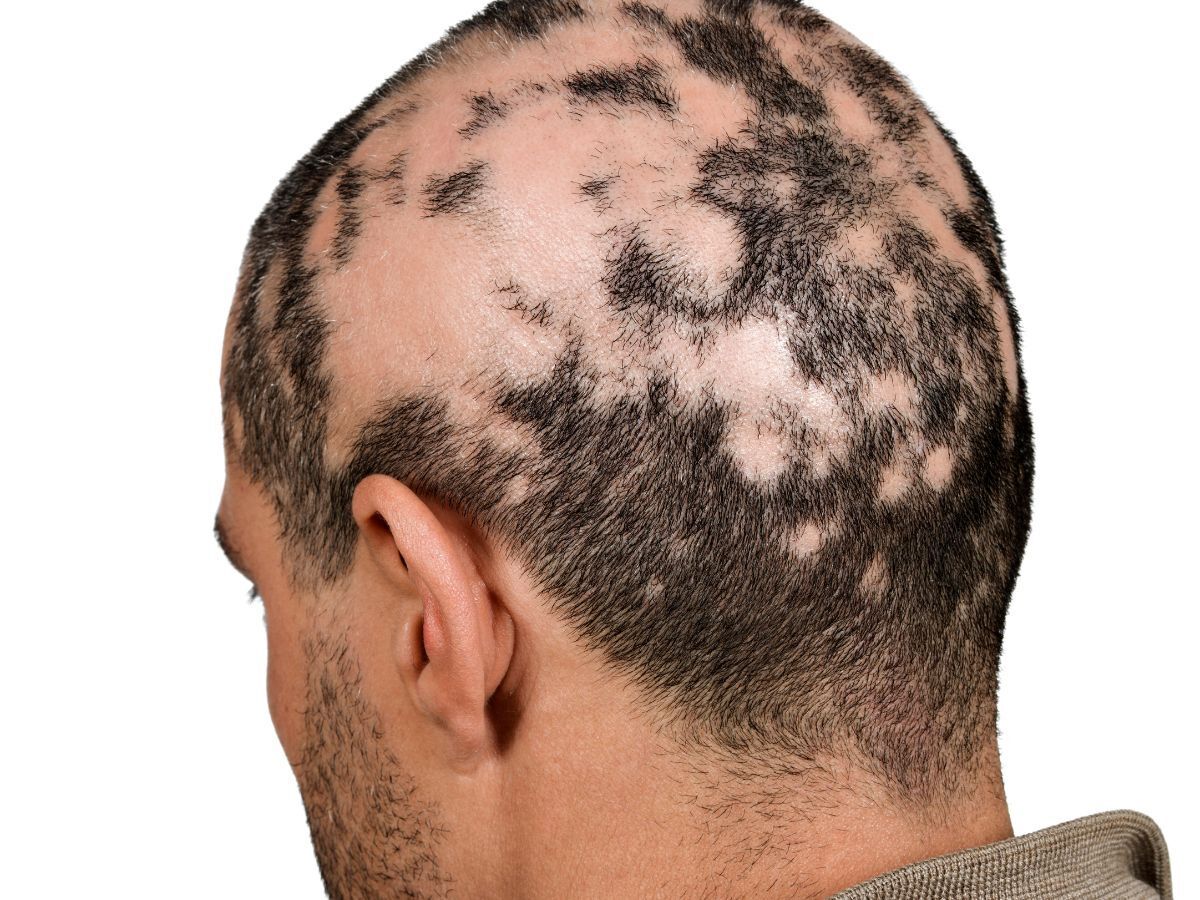 Best Trichologist in Dubai