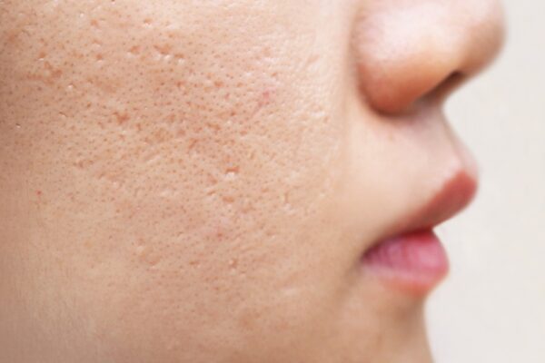 Does-Acne-Scar-Treatment-Work-on-All-Scar-Types