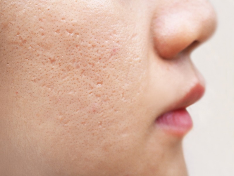 Does-Acne-Scar-Treatment-Work-on-All-Scar-Types