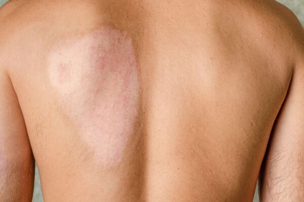 Does Burn Reconstructive Surgery Leave Scars? Does Burn Reconstructive Surgery Leave Scars