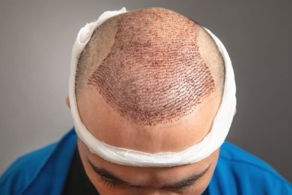 Does Hair Transplant Work on Large Bald Areas