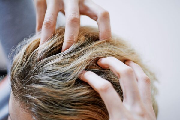 Crown Hair Transplant