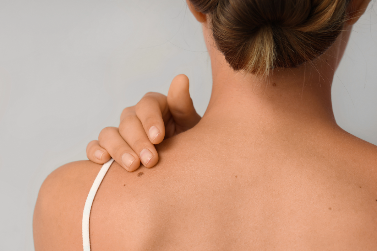 How Does Cryotherapy Mole Removal Treatment Work?