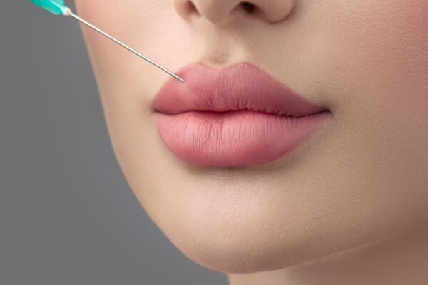 How Gradual Is Russian Lip Fillers Volume Gain