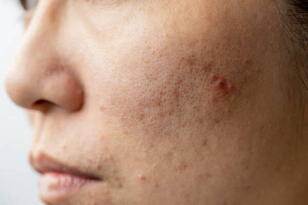 How Long Does Acne Treatment Last