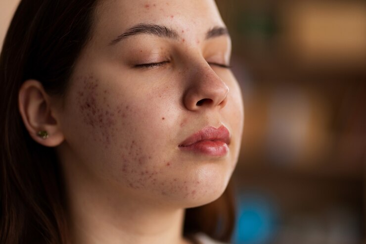 How Long Does Pigmentation Treatment Take