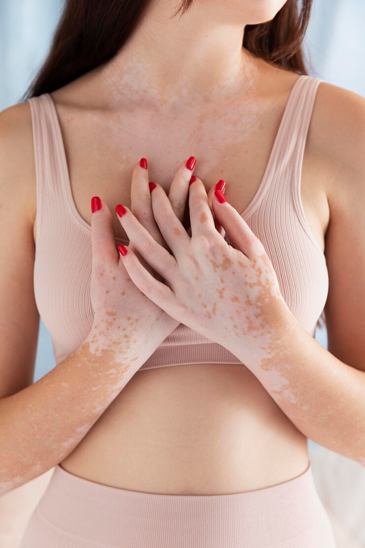 How Long Does Vitiligo Treatment Take