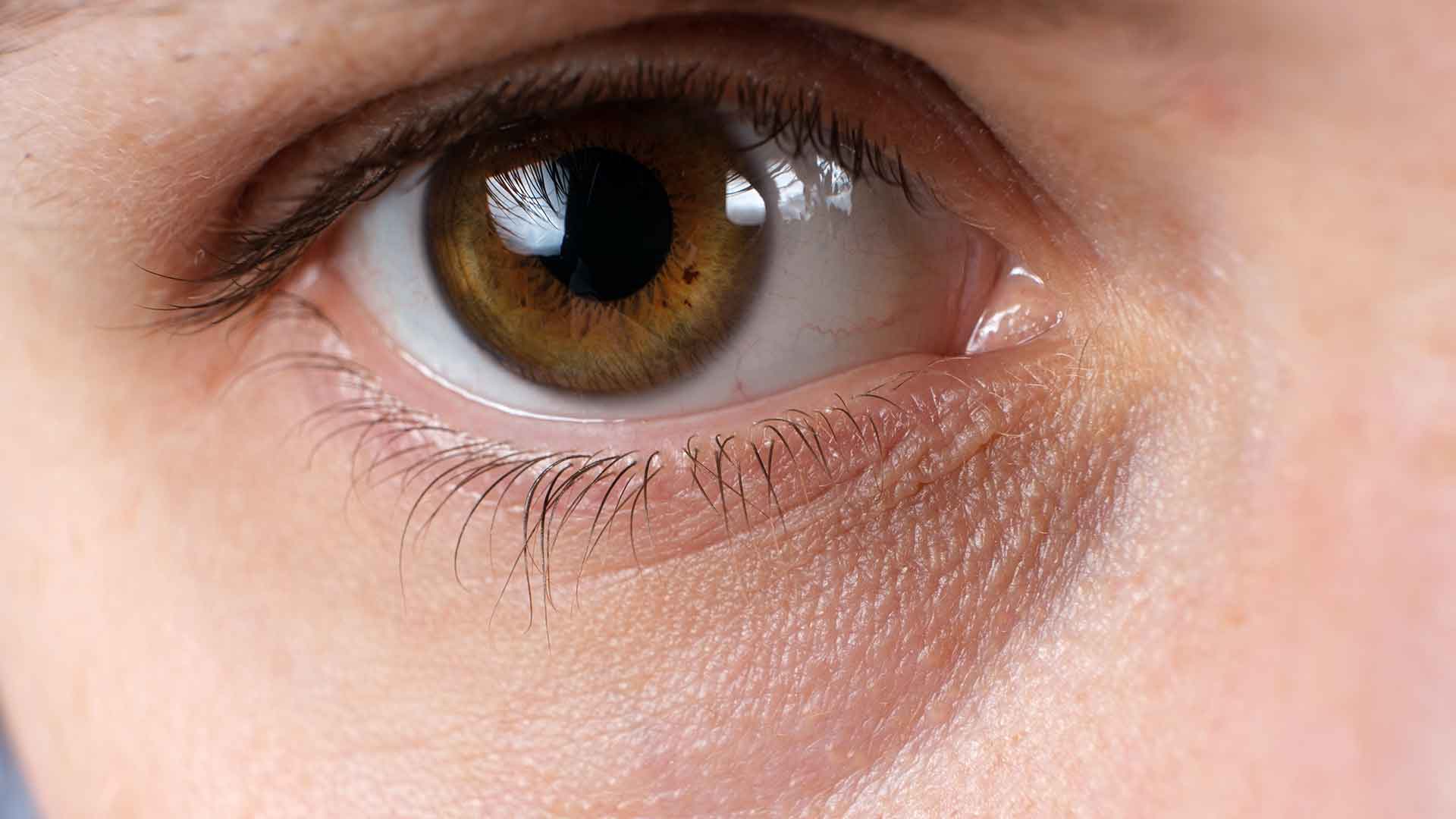 How to Speed Up Dark Circles Treatment Results