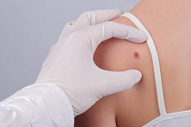 Is Benign Mole Removal Treatment Worth It