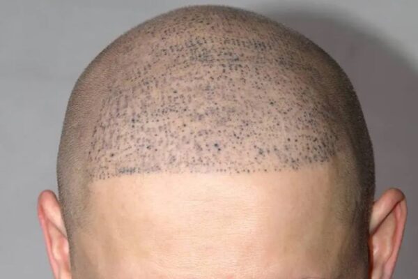 Is Scalp Micropigmentation Effective for Balding? Is Scalp Micropigmentation Effective for Balding