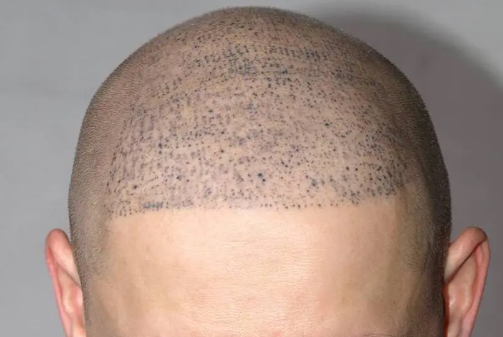 Is Scalp Micropigmentation Effective for Balding