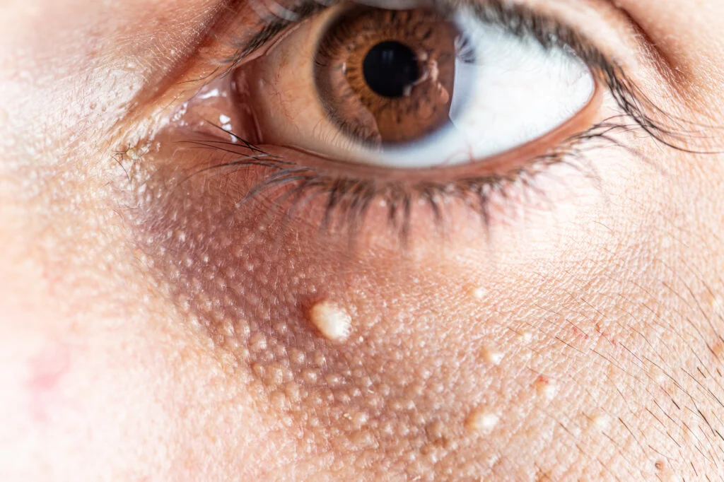 skin tag removal
