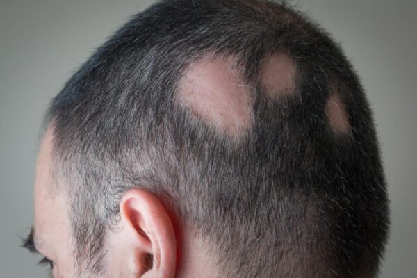 Does Hair Transplant Work for Patchy Baldness?