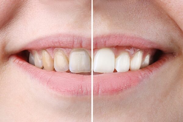 Teeth Whitening vs. At-Home Kits: What Works Best in Lake Mary?