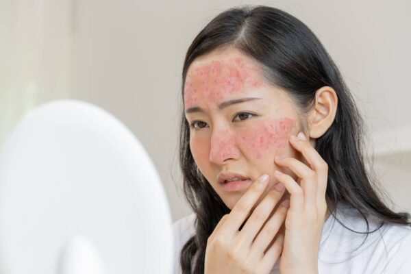 Rosacea Treatment