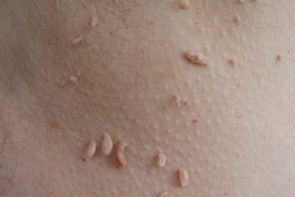 Does Skin Tag Removal Help Improve Skin Appearance Fast? Skin Tag Removal in Dubai,