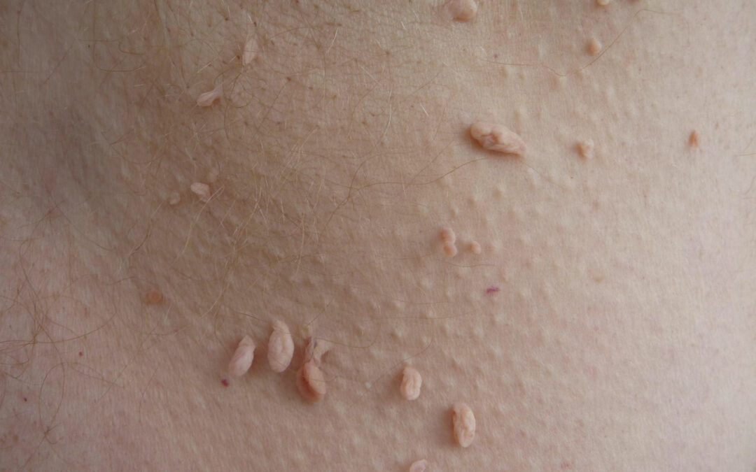 Skin Tag Removal in Dubai,