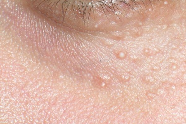 Milia Treatments