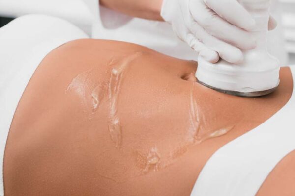 What Is Ultrasound Cavitation and How Does It Work