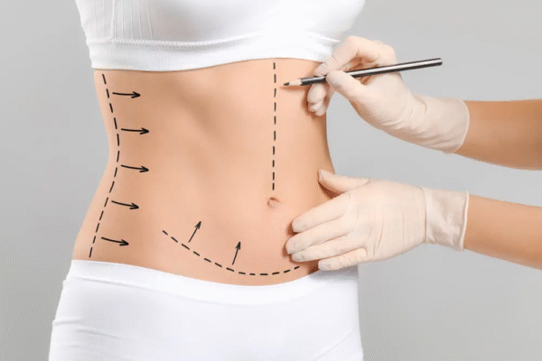 Is a Tummy Tuck Treatment Safe?