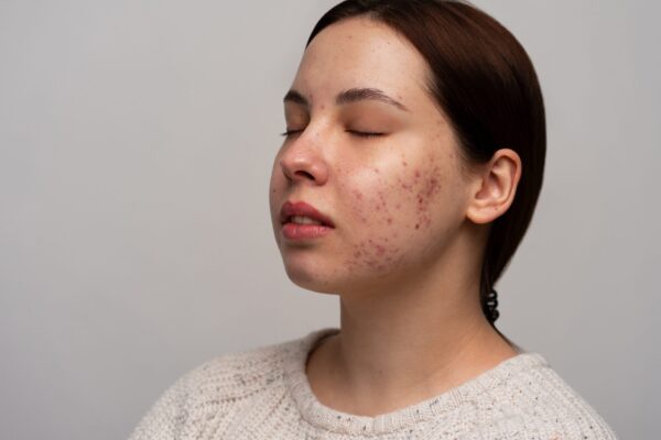 Can Skin Toning Treatment Treat Acne Marks