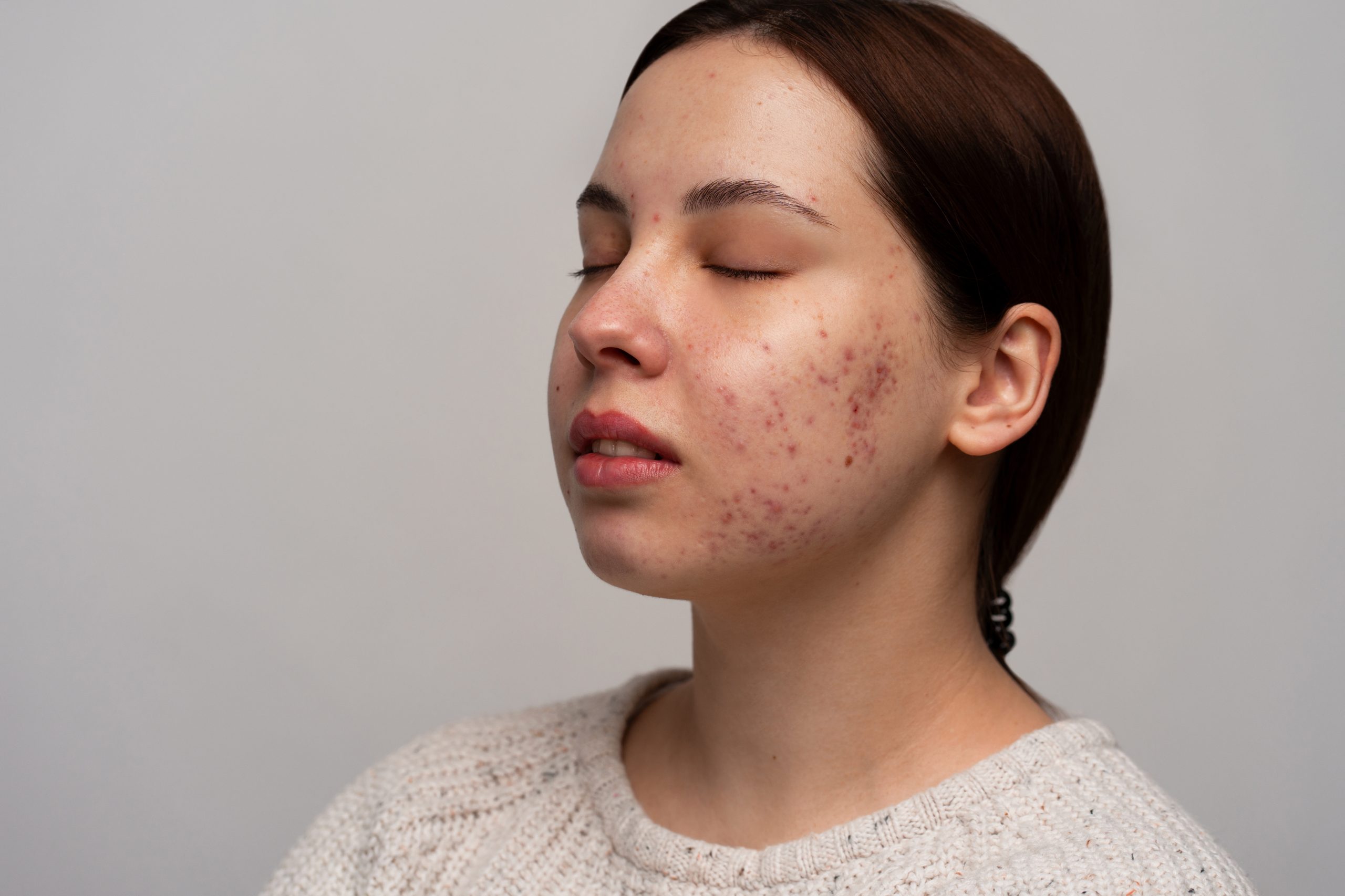 Can Skin Toning Treatment Treat Acne Marks