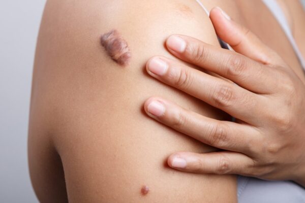 Can You Get Keloid Treatment While Pregnant? Can You Get Keloid Treatment While Pregnant