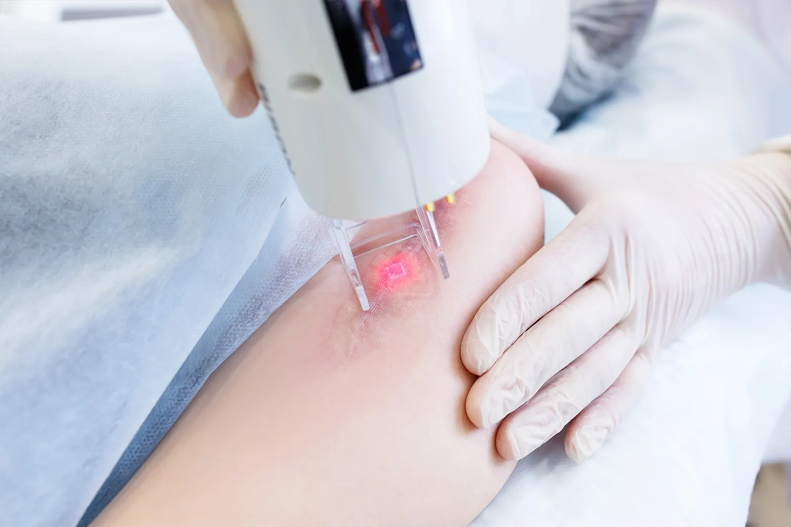 Does CO2 Laser Treatment Require Downtime?