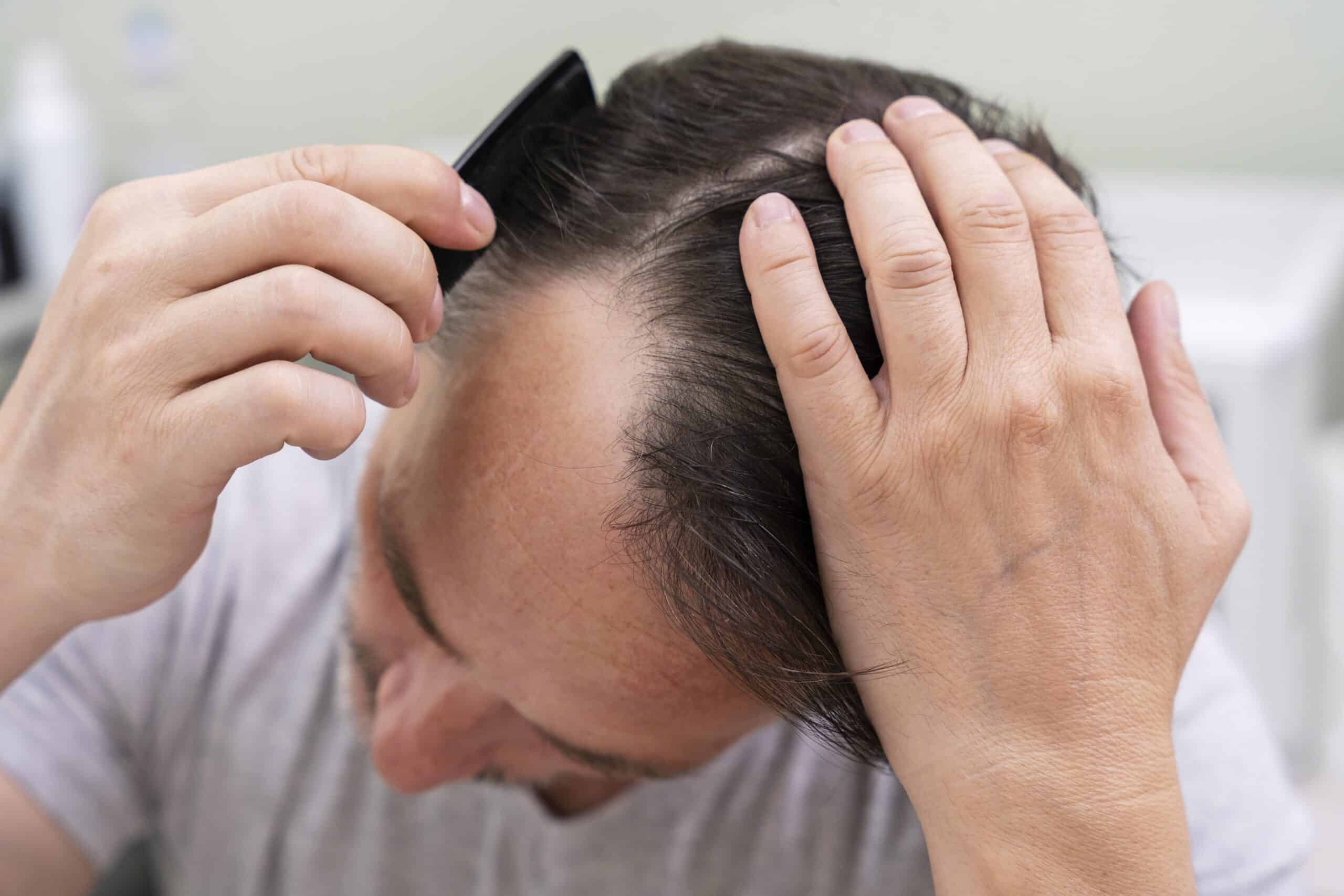 Does Hair Replacement Help with Full Baldness?